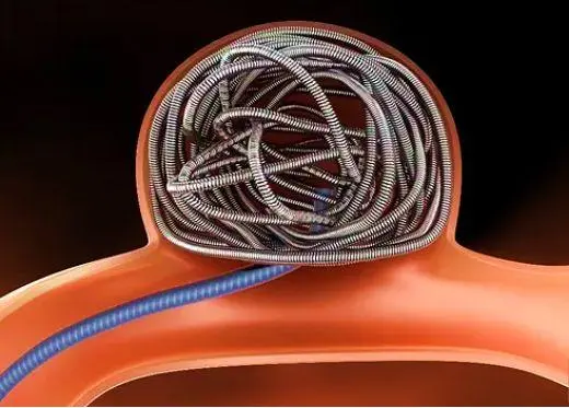  MA市場準入 | 神經介入②顱內彈簧圈系統(tǒng)-臨床評價路徑